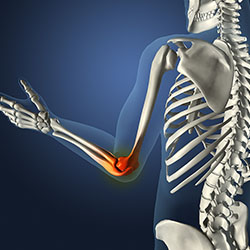 High Res 3D Rendering of Skeleton, Elbow Pain (Poser, Maya, Photoshop)